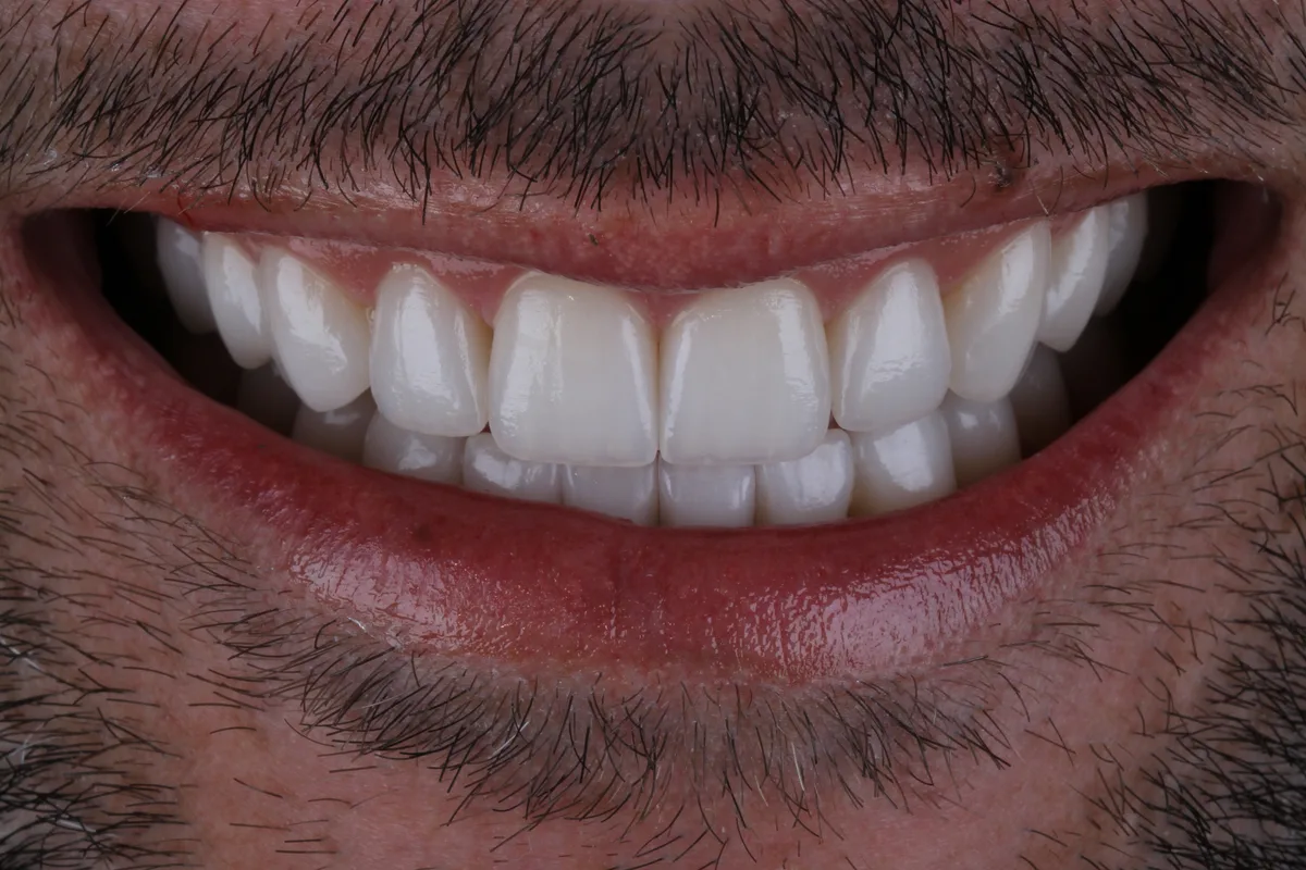 Depois — Reabilitação estética do sorriso, sorriso (caso real, Landgraf Odontologia Premier)