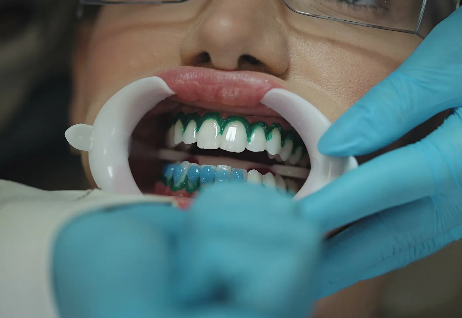 Aplicação do gel clareador com proteção da gengiva, em consultório — clareamento dental em Palmas/TO