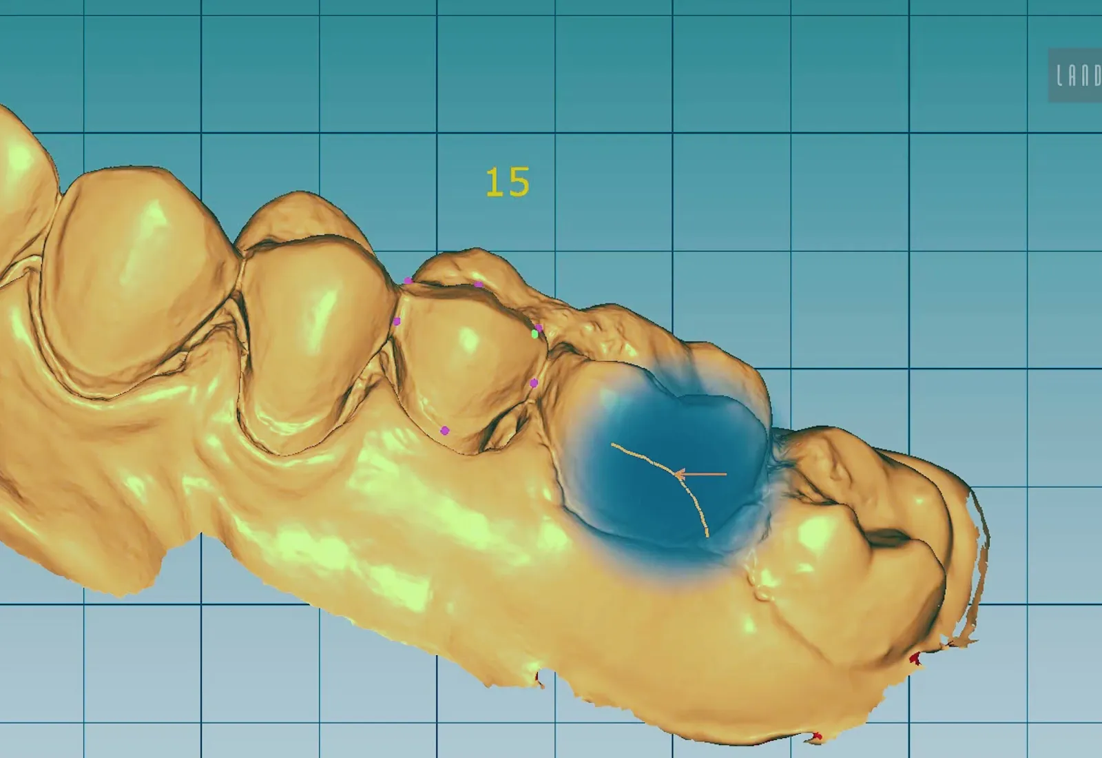 Planejamento digital 3D de arcada completa — protocolo sobre implantes em Palmas/TO